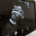 Close-up of an ultrasound showing a fetus on a monitor in a medical clinic.